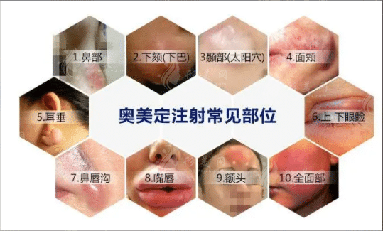 上海取奧美定最好的醫(yī)院有哪些？費(fèi)用是多少錢？取的干凈嗎？