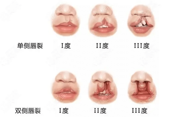 全國(guó)唇腭裂修復(fù)好的醫(yī)院排名分享｜這幾家口碑實(shí)力都不錯(cuò)
