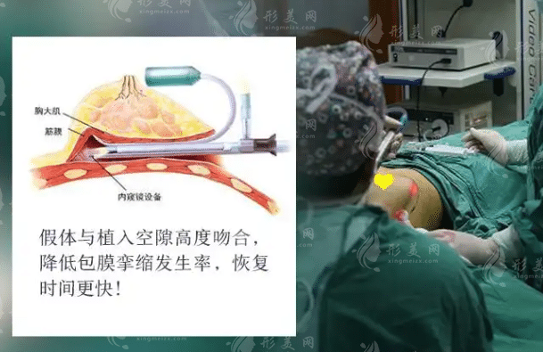 內(nèi)窺鏡假體豐胸多少錢？項目有危害嗎？