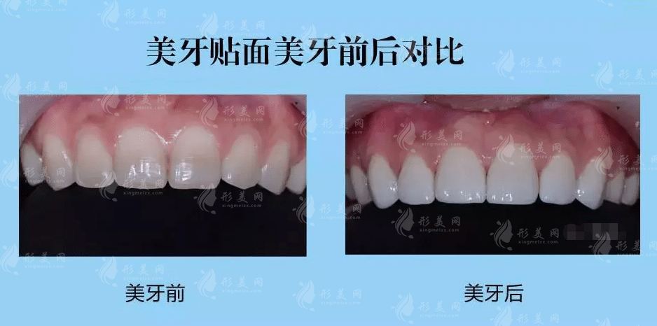 做牙齒貼面的時(shí)間長不長?
