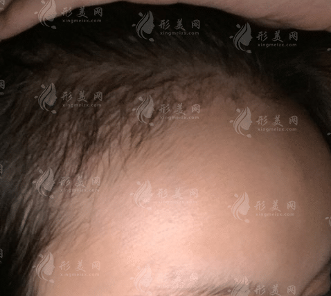 長(zhǎng)春韓尚植發(fā)醫(yī)院怎么樣？2022發(fā)際線種植案例展示