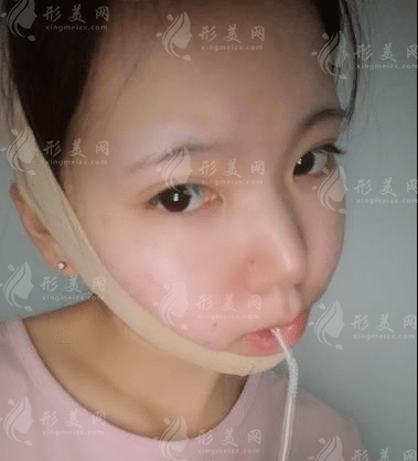 上海九院韋敏磨骨怎么樣？顴骨下頜角價格表|手術(shù)案例鑒賞