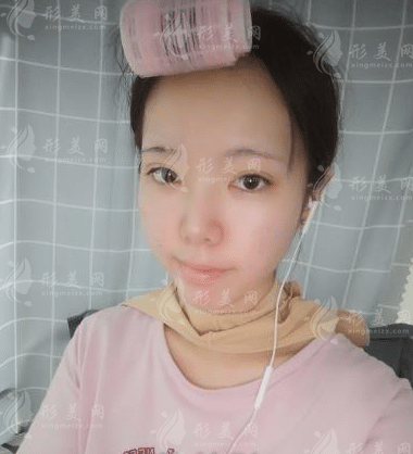 上海九院韋敏磨骨怎么樣？顴骨下頜角價格表|手術(shù)案例鑒賞
