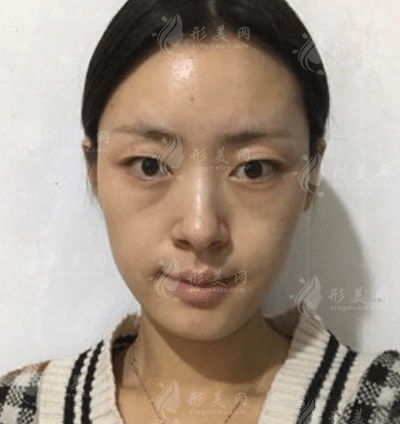 武漢協(xié)和醫(yī)院整形科做雙眼皮怎么樣？醫(yī)院實力及案例一覽