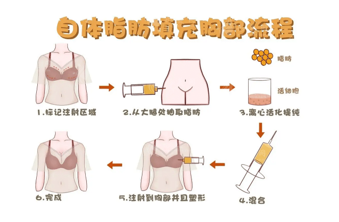 脂肪隆胸