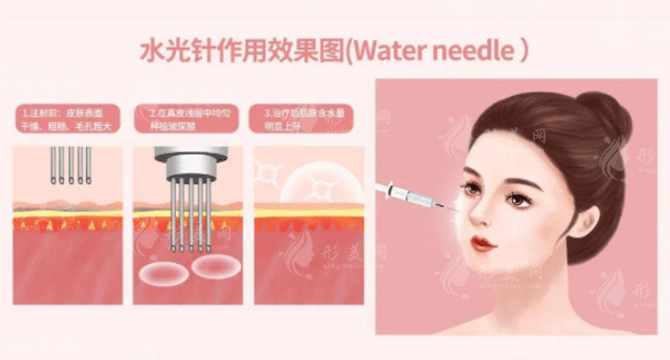 長效水光針真的長效嗎？長效水光針的種類有哪些？