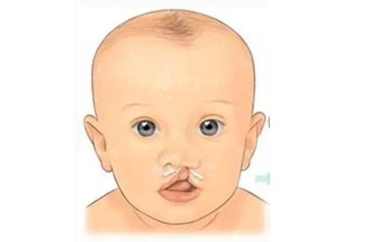 兔唇修復(fù)手術(shù)要多少錢？唇裂修復(fù)最佳年齡？?jī)r(jià)格高低波動(dòng)因素