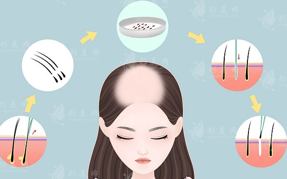 哈爾濱哪家植發(fā)醫(yī)院比較好？植發(fā)價(jià)格多少？詳情介紹速覽