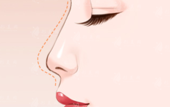 廈門鼻整形醫(yī)生排名前五，結(jié)尾附上隆鼻整形價格