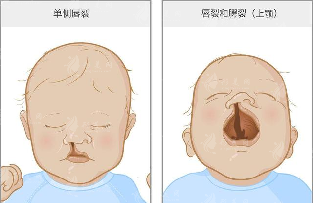 王馳做唇腭裂技術好嗎？