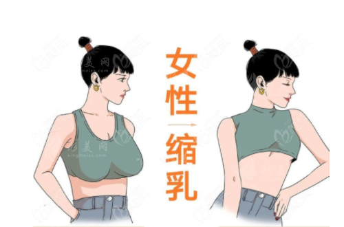 巨乳縮小手術(shù)有哪幾種方法？倒T、棒棒糖和雙環(huán)法的區(qū)別及價(jià)格