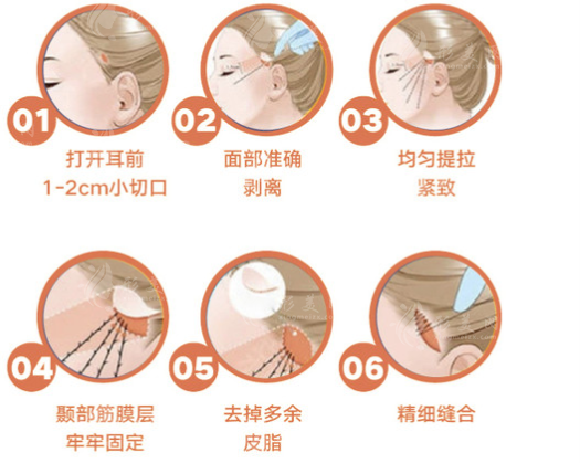 小切口提升