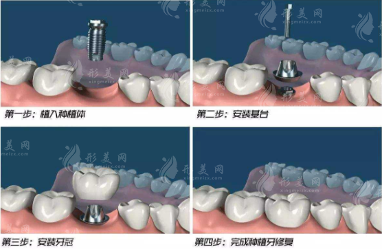 在北京種一顆牙大概需要多少錢？