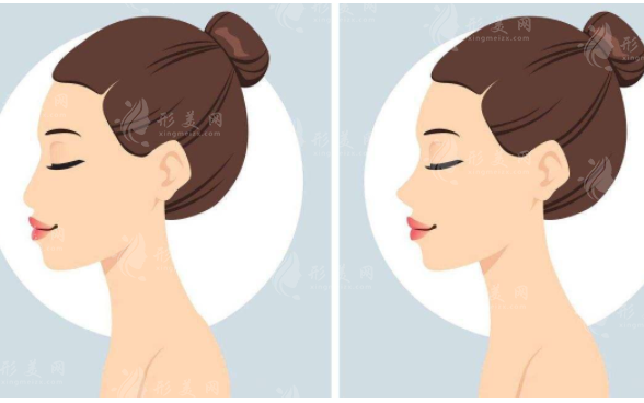 杭州格萊美做鼻子怎么樣？人氣醫(yī)生介紹+案例分享+整形價格表