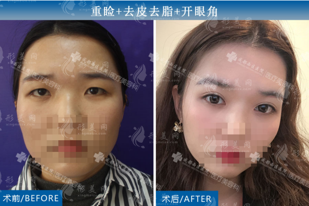 成都西區(qū)楊世界醫(yī)生案例展示
