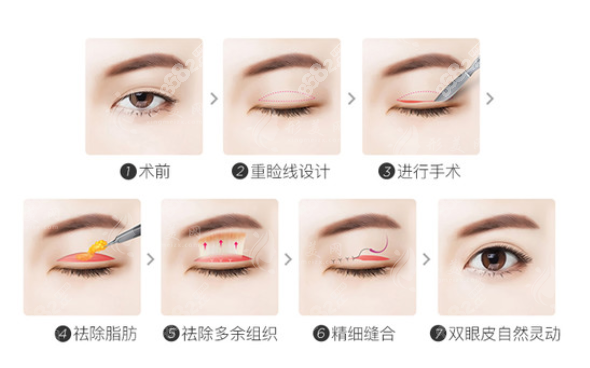 雙眼皮手術(shù)