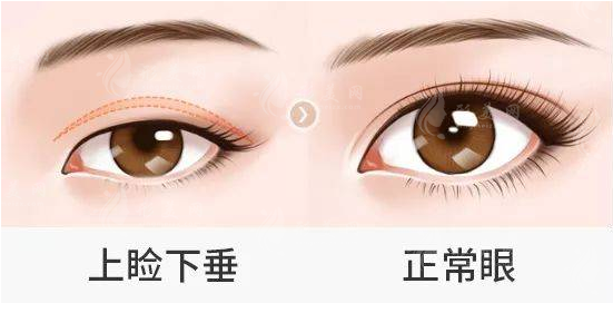 眼瞼下垂矯正方法是什么？上瞼提升術(shù)、眼輪匝肌重建術(shù)...