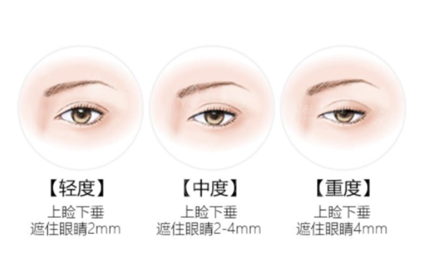 眼瞼下垂矯正方法是什么？上瞼提升術(shù)、眼輪匝肌重建術(shù)...