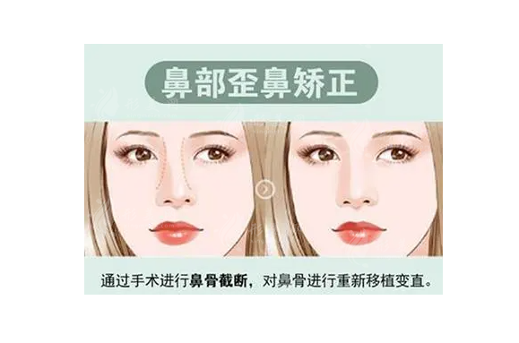 歪鼻矯正手術(shù)風(fēng)險(xiǎn)大嗎？手術(shù)大概多少錢(qián)？