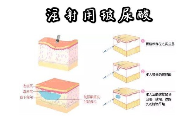 芙妮薇玻尿酸多少錢一支？效果能維持多久？