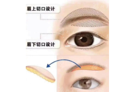 上眼瞼切皮手術(shù)好嗎？多久恢復自然？科普解答送給你
