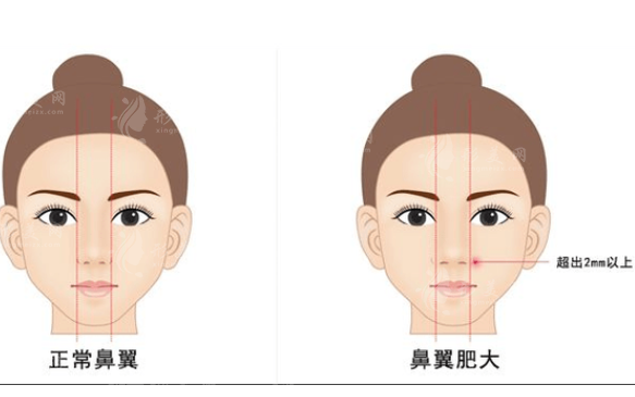 寬鼻矯正和鼻骨內(nèi)推一樣嗎？兩者有什么區(qū)別？