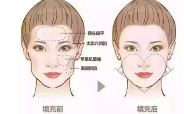 顴骨顴弓整形手術(shù)全過程是怎樣的？全步驟一覽