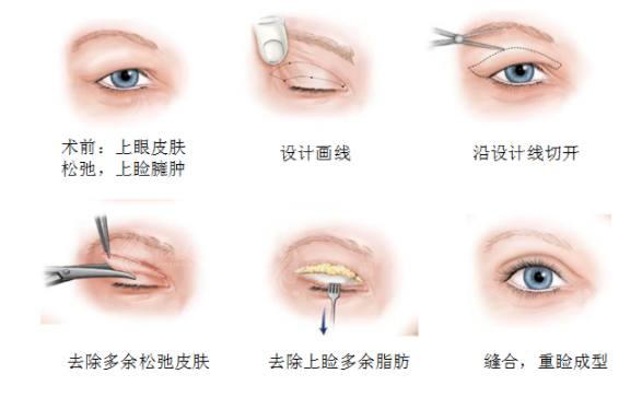 疤痕體質可以割雙眼皮嗎？術前要考慮哪些因素？