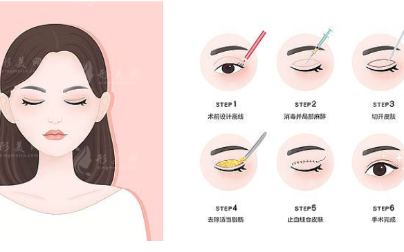 開眼角和割雙眼皮應(yīng)該一起做好還是分開做好？