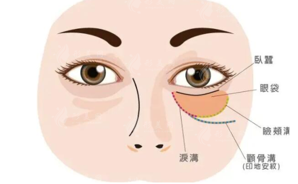 玻尿酸打臥蠶有風(fēng)險(xiǎn)嗎？主要包括哪些方面？