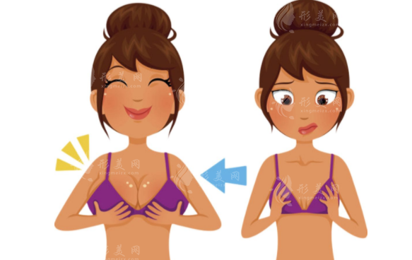 假體隆胸手術方法有哪些？乳暈切口好嗎？