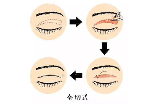 雙眼皮整形