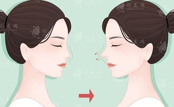 鼻子假體能永久帶嗎？下面我們一起來看看吧