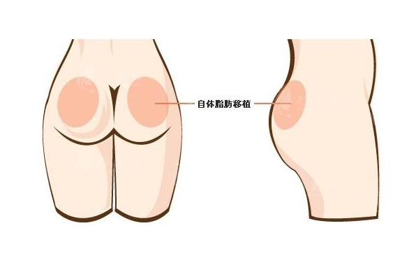 自體脂肪豐臀會(huì)下垂嗎？什么原因?qū)е碌哪兀?></a><p class=