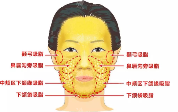 水動力面部吸脂效果好嗎？一起來了解一下