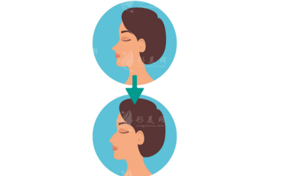 什么是自體筋膜隆鼻？手術(shù)包括哪些步驟？