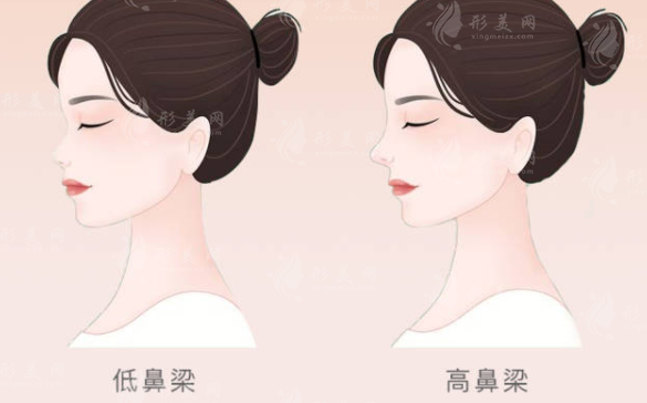 膨體隆鼻有后遺癥嗎？出現(xiàn)以下情況要注意