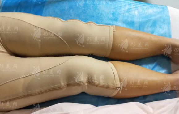 大腿吸脂一個月后還會再繼續(xù)瘦嗎？術(shù)后要注意什么？
