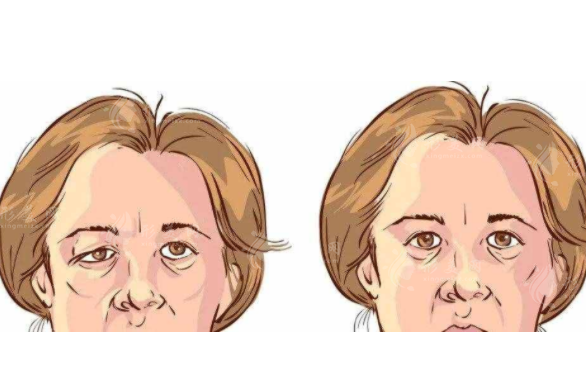 眼皮松弛怎么改善，是做雙眼皮好還是做切眉好？