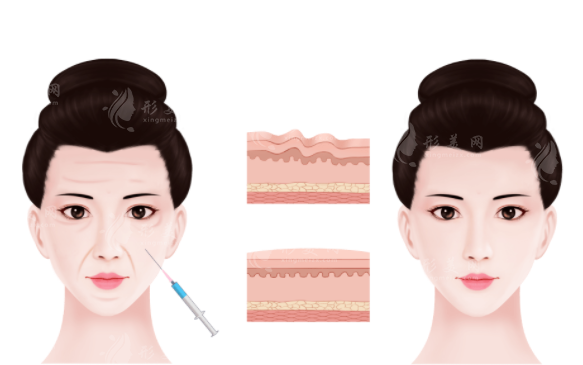 經(jīng)常打面部除皺針術(shù)后有什么副作用嗎？