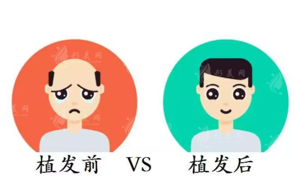 頭發(fā)種植原理是什么？下文為你介紹分享