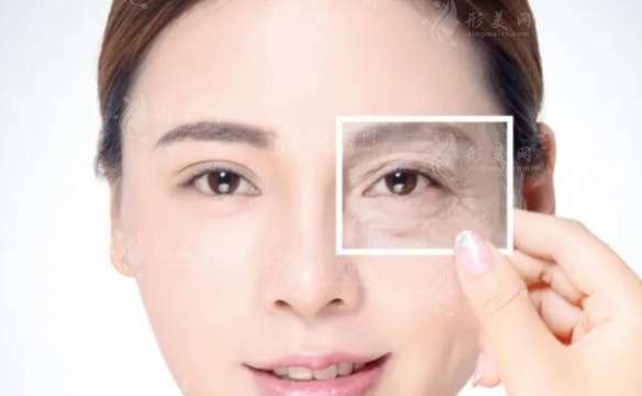 眼部除皺有什么優(yōu)點？拉皮和除皺針眼部除皺的區(qū)別
