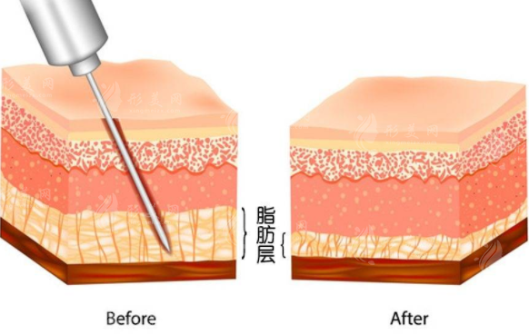 吸脂多久看到效果？所有人都適合吸脂嗎？吸脂必看