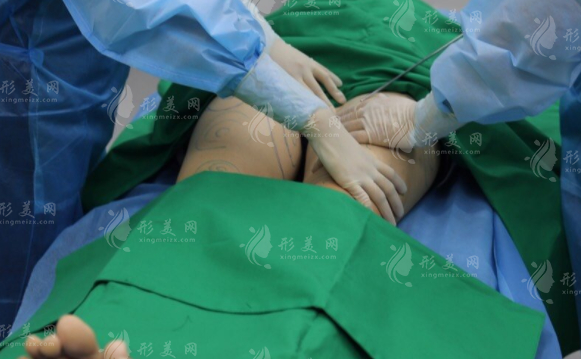為何大腿吸脂容易出現(xiàn)凹凸不平的情況，而腰腹吸脂卻沒有？