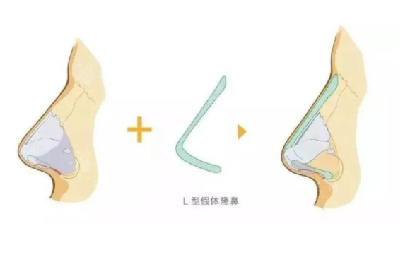 上海九院做假體隆鼻多少錢？專業(yè)醫(yī)生介紹+案例分享+價格2023新版~