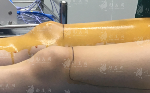 大腿吸脂完之后要怎么做？有硬塊怎么消除？