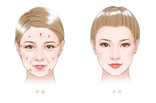 上海仁濟醫(yī)院整形外科拉皮提升