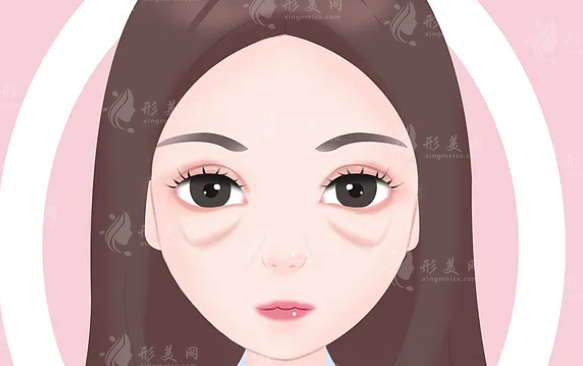 西京醫(yī)院割眼袋誰(shuí)做的好？割眼袋案例分享、收費(fèi)價(jià)格一覽