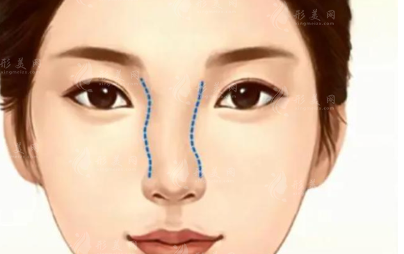 歪鼻矯正手術(shù)風(fēng)險(xiǎn)大嗎？術(shù)后有后遺癥嗎？