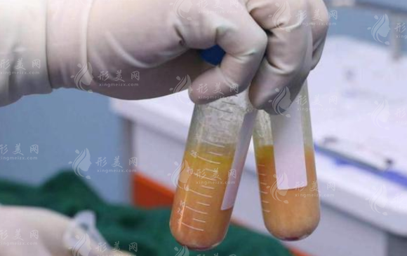 大腿吸脂要分多次進(jìn)行嗎？大腿吸脂后多久可以正常外出？